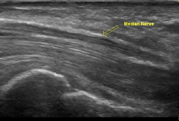 Peripheral Nerves Ultrasound
